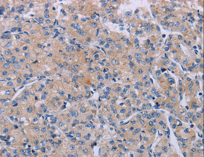 P2RX3 / P2X3 Antibody - Immunohistochemistry of paraffin-embedded Human prostate cancer using P2RX3 Polyclonal Antibody at dilution of 1:50.