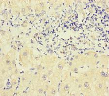 P2RX3 / P2X3 Antibody - Immunohistochemistry of paraffin-embedded human liver cancer at dilution of 1:100