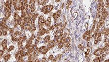 P2RX7 / P2X7 Antibody - 1:100 staining human liver carcinoma tissues by IHC-P. The sample was formaldehyde fixed and a heat mediated antigen retrieval step in citrate buffer was performed. The sample was then blocked and incubated with the antibody for 1.5 hours at 22°C. An HRP conjugated goat anti-rabbit antibody was used as the secondary.