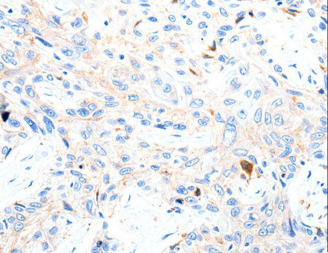 P2RY1 / P2Y1 Antibody - Immunohistochemistry of paraffin-embedded Human esophagus cancer using P2RY1 Polyclonal Antibody at dilution of 1:50.
