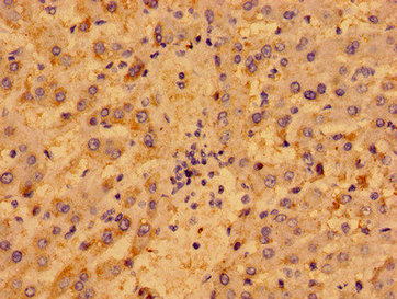 P2RY1 / P2Y1 Antibody - Immunohistochemistry image of paraffin-embedded human liver cancer at a dilution of 1:100