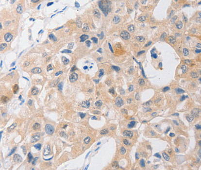 P2RY11 / P2Y11 Antibody - Immunohistochemistry of paraffin-embedded human lung cancer tissue.