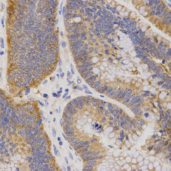 P2RY11 / P2Y11 Antibody - Immunohistochemistry of paraffin-embedded human rectal cancer tissue.