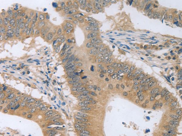 P2RY11 / P2Y11 Antibody - Immunohistochemistry of paraffin-embedded Human colon cancer tissue  using P2RY11 Polyclonal Antibody at dilution of 1:30(×200)