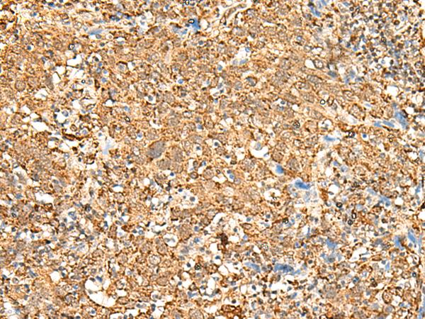 P2RY14 / GPR105 Antibody - Immunohistochemistry of paraffin-embedded Human cervical cancer tissue  using P2RY14 Polyclonal Antibody at dilution of 1:25(×200)