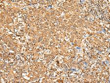 P2RY14 / GPR105 Antibody - Immunohistochemistry of paraffin-embedded Human cervical cancer tissue  using P2RY14 Polyclonal Antibody at dilution of 1:25(×200)