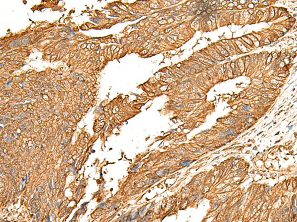 P2RY14 / GPR105 Antibody - Immunohistochemistry of paraffin-embedded Human colorectal cancer tissue  using P2RY14 Polyclonal Antibody at dilution of 1:25(×200)