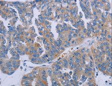 P2RY2 / P2Y2 Antibody - Immunohistochemistry of paraffin-embedded Human prostate cancer using P2RY2 Polyclonal Antibody at dilution of 1:40.