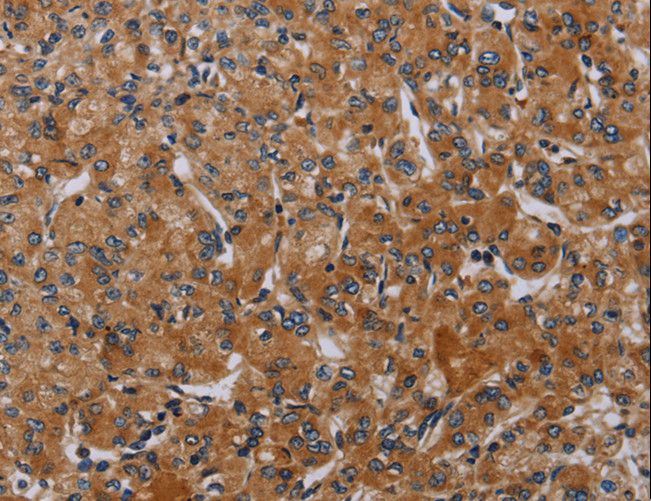 P2RY2 / P2Y2 Antibody - Immunohistochemistry of paraffin-embedded Human prostate cancer using P2RY2 Polyclonal Antibody at dilution of 1:40.