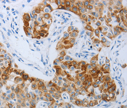 P2RY4 / P2Y4 Antibody - Immunohistochemistry of paraffin-embedded Human lung cancer tissue.