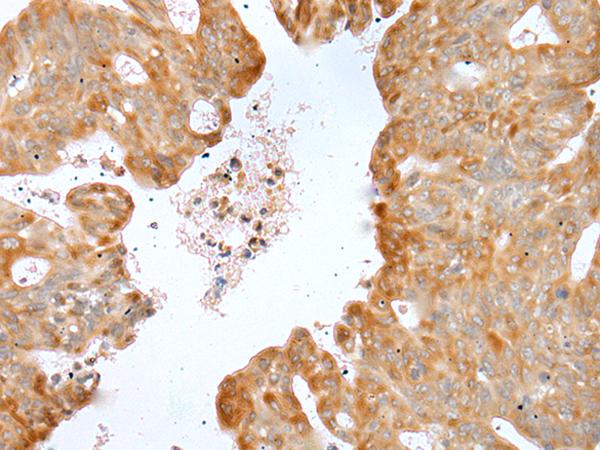 P2RY4 / P2Y4 Antibody - Immunohistochemistry of paraffin-embedded Human gastric cancer tissue  using P2RY4 Polyclonal Antibody at dilution of 1:40(×200)