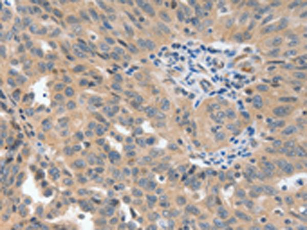 P2RY6 / P2Y6 Antibody - Immunohistochemistry of paraffin-embedded Human ovarian cancer tissue  using P2RY6 Polyclonal Antibody at dilution of 1:40(×200)