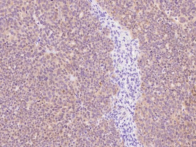 P2RY6 / P2Y6 Antibody - Immunochemical staining of human P2RY6 in human ovarian cancer with rabbit polyclonal antibody at 1:1000 dilution, formalin-fixed paraffin embedded sections.