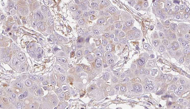 P2Y10 / P2RY10 Antibody - 1:100 staining human liver carcinoma tissues by IHC-P. The sample was formaldehyde fixed and a heat mediated antigen retrieval step in citrate buffer was performed. The sample was then blocked and incubated with the antibody for 1.5 hours at 22°C. An HRP conjugated goat anti-rabbit antibody was used as the secondary.