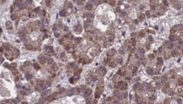 P2Y13 / P2RY13 Antibody - 1:100 staining human liver carcinoma tissues by IHC-P. The sample was formaldehyde fixed and a heat mediated antigen retrieval step in citrate buffer was performed. The sample was then blocked and incubated with the antibody for 1.5 hours at 22°C. An HRP conjugated goat anti-rabbit antibody was used as the secondary.