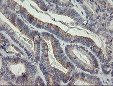 P3H1 / LEPRE1 Antibody - IHC of paraffin-embedded Adenocarcinoma of Human endometrium tissue using anti-LEPRE1 mouse monoclonal antibody.