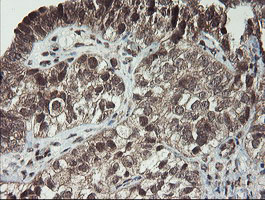 P3H1 / LEPRE1 Antibody - IHC of paraffin-embedded Adenocarcinoma of Human ovary tissue using anti-LEPRE1 mouse monoclonal antibody. (Heat-induced epitope retrieval by 10mM citric buffer, pH6.0, 100C for 10min).