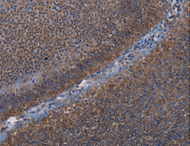 P3H3 / LEPREL2 Antibody - Immunohistochemistry of paraffin-embedded Human rectal cancer using LEPREL2 Polyclonal Antibody at dilution of 1:50.