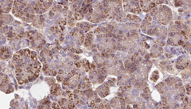 P3H3 / LEPREL2 Antibody - 1:100 staining human pancreas carcinoma tissue by IHC-P. The sample was formaldehyde fixed and a heat mediated antigen retrieval step in citrate buffer was performed. The sample was then blocked and incubated with the antibody for 1.5 hours at 22°C. An HRP conjugated goat anti-rabbit antibody was used as the secondary.