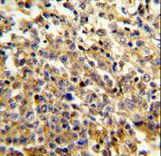 P40PHOX / NCF4 Antibody - Formalin-fixed and paraffin-embedded human lymphoma reacted with NCF4 Antibody , which was peroxidase-conjugated to the secondary antibody, followed by DAB staining. This data demonstrates the use of this antibody for immunohistochemistry; clinical relevance has not been evaluated.