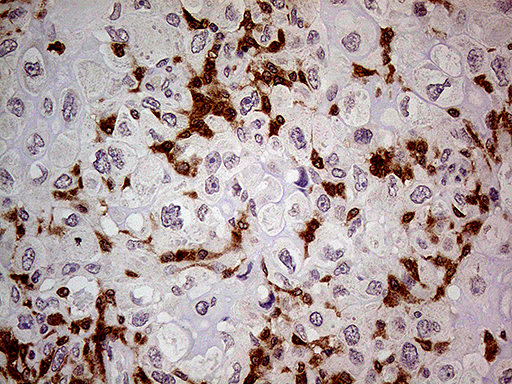 P40PHOX / NCF4 Antibody - Immunohistochemical staining of paraffin-embedded Adenocarcinoma of Human breast tissue tissue using anti-NCF4 mouse monoclonal antibody. (Heat-induced epitope retrieval by 1mM EDTA in 10mM Tris buffer. (pH8.5) at 120°C for 3 min. (1:500)