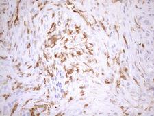 P40PHOX / NCF4 Antibody - Immunohistochemical staining of paraffin-embedded Adenocarcinoma of Human endometrium tissue using anti-NCF4 mouse monoclonal antibody. (Heat-induced epitope retrieval by 1mM EDTA in 10mM Tris buffer. (pH8.5) at 120°C for 3 min. (1:150)