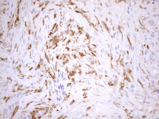 P40PHOX / NCF4 Antibody - Immunohistochemical staining of paraffin-embedded Adenocarcinoma of Human endometrium tissue using anti-NCF4 mouse monoclonal antibody. (Heat-induced epitope retrieval by 1mM EDTA in 10mM Tris buffer. (pH8.5) at 120°C for 3 min. (1:150)