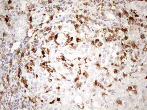 P40PHOX / NCF4 Antibody - Immunohistochemical staining of paraffin-embedded Carcinoma of Human liver tissue using anti-NCF4 mouse monoclonal antibody. (Heat-induced epitope retrieval by 1mM EDTA in 10mM Tris buffer. (pH8.5) at 120°C for 3 min. (1:150)