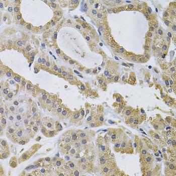 P40PHOX / NCF4 Antibody - Immunohistochemistry of paraffin-embedded Human thyroid cancer using NCF4 Polyclonal Antibody at dilution of 1:100 (40x lens).