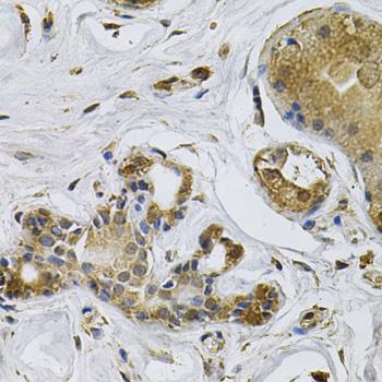 P40PHOX / NCF4 Antibody - Immunohistochemistry of paraffin-embedded Human breast cancer using NCF4 Polyclonal Antibody at dilution of 1:100 (40x lens).