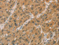P450SCC / CYP11A1 Antibody - Immunohistochemistry of paraffin-embedded Human gastric cancer using CYP11A1 Polyclonal Antibody at dilution of 1:50.