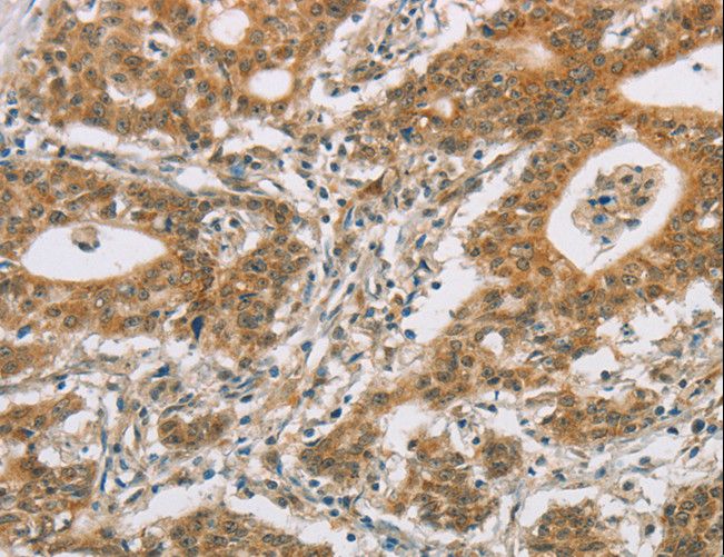 P450SCC / CYP11A1 Antibody - Immunohistochemistry of paraffin-embedded Human gastric cancer using CYP11A1 Polyclonal Antibody at dilution of 1:50.