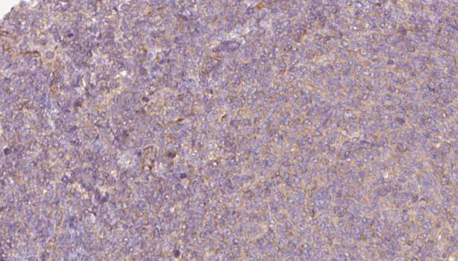 P4HA1 Antibody - 1:100 staining human lymph carcinoma tissue by IHC-P. The sample was formaldehyde fixed and a heat mediated antigen retrieval step in citrate buffer was performed. The sample was then blocked and incubated with the antibody for 1.5 hours at 22°C. An HRP conjugated goat anti-rabbit antibody was used as the secondary.
