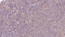 P4HA1 Antibody - 1:100 staining human lymph carcinoma tissue by IHC-P. The sample was formaldehyde fixed and a heat mediated antigen retrieval step in citrate buffer was performed. The sample was then blocked and incubated with the antibody for 1.5 hours at 22°C. An HRP conjugated goat anti-rabbit antibody was used as the secondary.