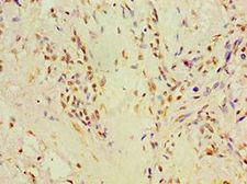 P4HA2 Antibody - Immunohistochemistry of paraffin-embedded human breast cancer using antibody at 1:100 dilution.