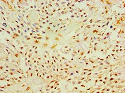 P4HA2 Antibody - Immunohistochemistry of paraffin-embedded human breast cancer using antibody at 1:100 dilution.