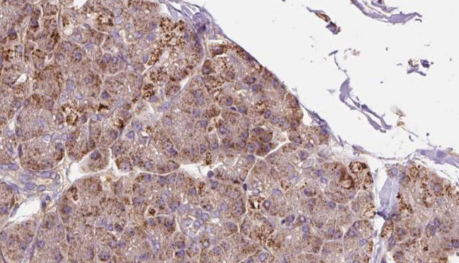 P4HA2 Antibody - 1:100 staining human pancreas carcinoma tissue by IHC-P. The sample was formaldehyde fixed and a heat mediated antigen retrieval step in citrate buffer was performed. The sample was then blocked and incubated with the antibody for 1.5 hours at 22°C. An HRP conjugated goat anti-rabbit antibody was used as the secondary.