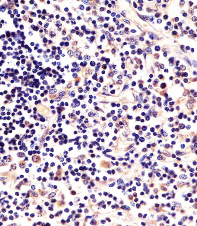 p56lck / LCK Antibody - Antibody staining LCK in human thymus sections by Immunohistochemistry (IHC-P - paraformaldehyde-fixed, paraffin-embedded sections). Tissue was fixed with formaldehyde and blocked with 3% BSA for 0. 5 hour at room temperature; antigen retrieval was by heat mediation with a citrate buffer (pH 6). Samples were incubated with primary antibody (1:25) for 1 hours at 37°C. A undiluted biotinylated goat polyvalent antibody was used as the secondary antibody.