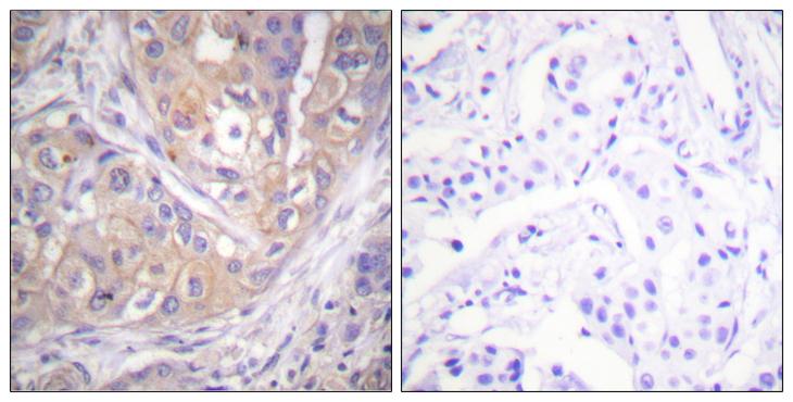 p56lck / LCK Antibody - Immunohistochemistry analysis of paraffin-embedded human breast carcinoma, using Lck (Phospho-Tyr505) Antibody. The picture on the right is blocked with the phospho peptide.