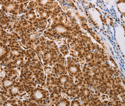 p58 / PSMD3 Antibody - Immunohistochemistry of paraffin-embedded human thyroid cancer tissue.