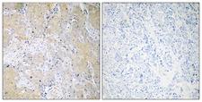 p58 / PSMD3 Antibody - Peptide - + Immunohistochemistry analysis of paraffin-embedded human breast carcinoma tissue using PSMD3 antibody.