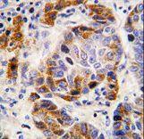 P5CDH / ALDH4A1 Antibody - Formalin-fixed and paraffin-embedded human hepatocarcinoma tissue reacted with ALDH4A1 antibody , which was peroxidase-conjugated to the secondary antibody, followed by DAB staining. This data demonstrates the use of this antibody for immunohistochemistry; clinical relevance has not been evaluated.