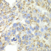 P5CDH / ALDH4A1 Antibody - Immunohistochemistry of paraffin-embedded human esophageal cancer tissue.