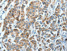 P5CDH / ALDH4A1 Antibody - Immunohistochemistry of paraffin-embedded Human breast cancer using ALDH4A1 Polyclonal Antibody at dilution of 1:45.