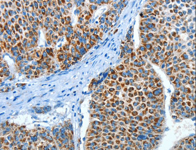 P5CDH / ALDH4A1 Antibody - Immunohistochemistry of paraffin-embedded Human liver cancer using ALDH4A1 Polyclonal Antibody at dilution of 1:45.