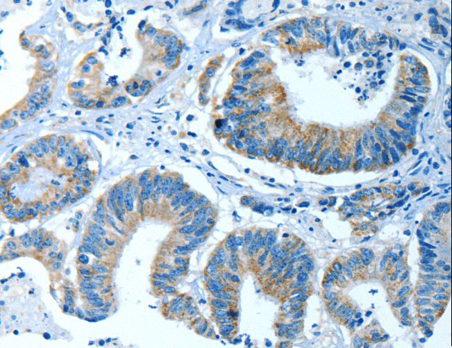 P5CDH / ALDH4A1 Antibody - Immunohistochemistry of paraffin-embedded Human colon cancer using ALDH4A1 Polyclonal Antibody at dilution of 1:35.