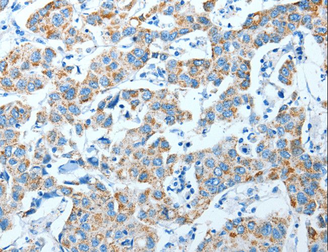 P5CDH / ALDH4A1 Antibody - Immunohistochemistry of paraffin-embedded Human breast cancer using ALDH4A1 Polyclonal Antibody at dilution of 1:35.