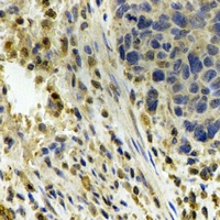 P5CDH / ALDH4A1 Antibody - Immunohistochemical analysis of ALDH4A1 staining in human esophageal cancer formalin fixed paraffin embedded tissue section. The section was pre-treated using heat mediated antigen retrieval with sodium citrate buffer (pH 6.0). The section was then incubated with the antibody at room temperature and detected using an HRP conjugated compact polymer system. DAB was used as the chromogen. The section was then counterstained with hematoxylin and mounted with DPX.