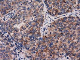 P5CR2 / PYCR2 Antibody - IHC of paraffin-embedded Adenocarcinoma of Human ovary tissue using anti-PYCR2 mouse monoclonal antibody.