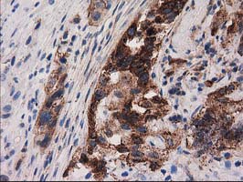 P5CR2 / PYCR2 Antibody - IHC of paraffin-embedded Carcinoma of Human bladder tissue using anti-PYCR2 mouse monoclonal antibody.